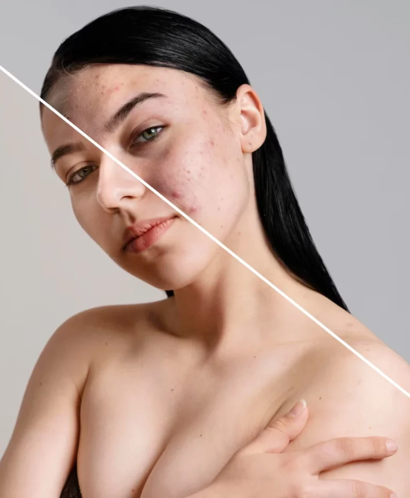 Acne and Scar treatment