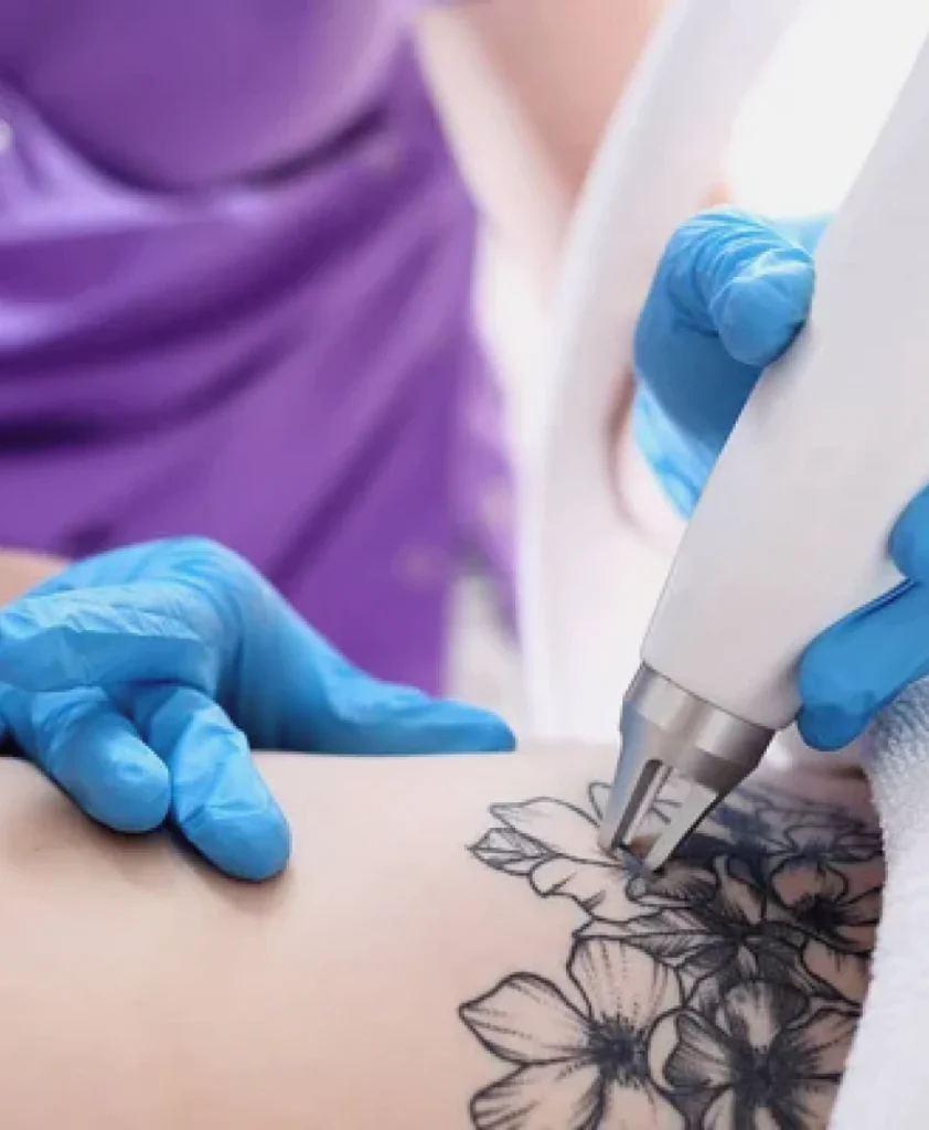 Tattoo Removal